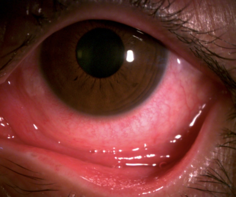 Tự ý mua thuốc chữa đau mắt đỏ tại nhà, nhiều người biến chứng nặng, có nguy cơ ảnh hưởng đến thị lực - Ảnh 1