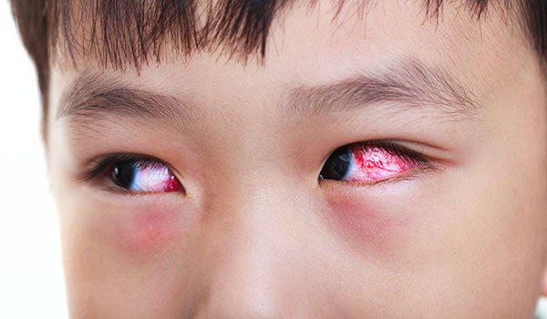 Dịch đau mắt đỏ tấn công trường học, lây lan chóng mặt, nhiều gia đình nghỉ học, nghỉ làm vì nhiễm bệnh - Ảnh 1