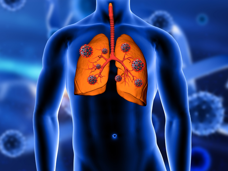 4 dấu hiệu sớm của ung thư phổi mà ai cũng nên biết để kịp thời chữa trị - Ảnh 1