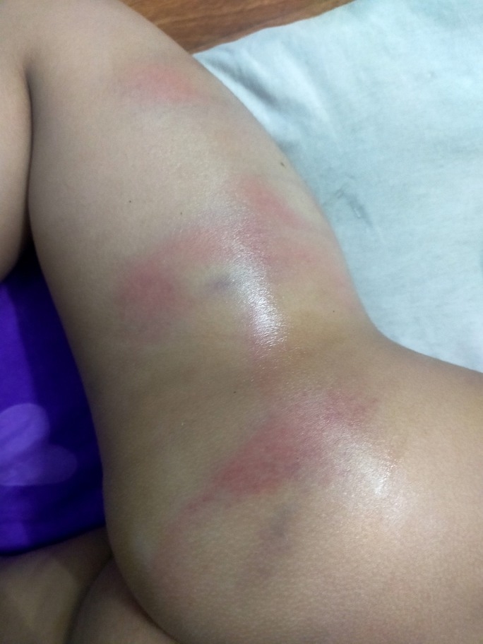 Vụ bé gái 4 tuổi bị cô giáo đánh bầm tím ở trường : Công an chính thức vào cuộc xác minh - Ảnh 1