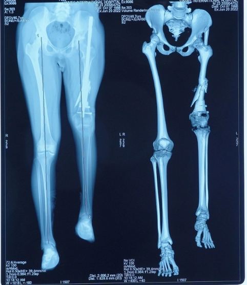 Lần đầu tiên tại Việt Nam, kéo dài chân 13cm cho bệnh nhân ung thư xương - Ảnh 3