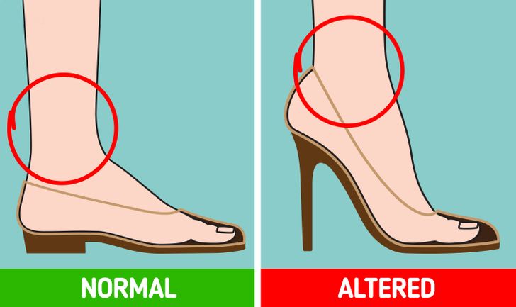 Đi giày cao gót mỗi ngày: Thói quen gây mòn sụn đĩa đệm, áp lực 'kinh hoàng' lên đầu gối và mắt cá chân  - Ảnh 4