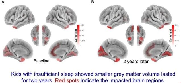 Đại học Y khoa của Mỹ phát hiện: Trẻ ngủ không đủ 9 giờ mỗi đêm sẽ có ít chất xám hơn - Ảnh 1