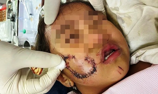 Bé gái 5 tuổi phải khâu 50 mũi vì bị chó nhà hàng xóm cắn vào mặt - Ảnh 1
