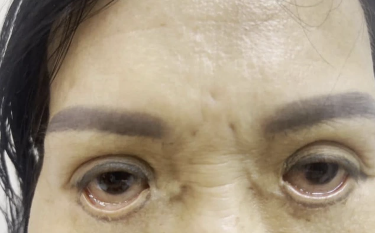 Sau 2 tháng cắt mí, người phụ nữ 45 tuổi 'gặp hoạ': Mắt 'con đậu, con bay', ánh nhìn lờ đờ - Ảnh 2