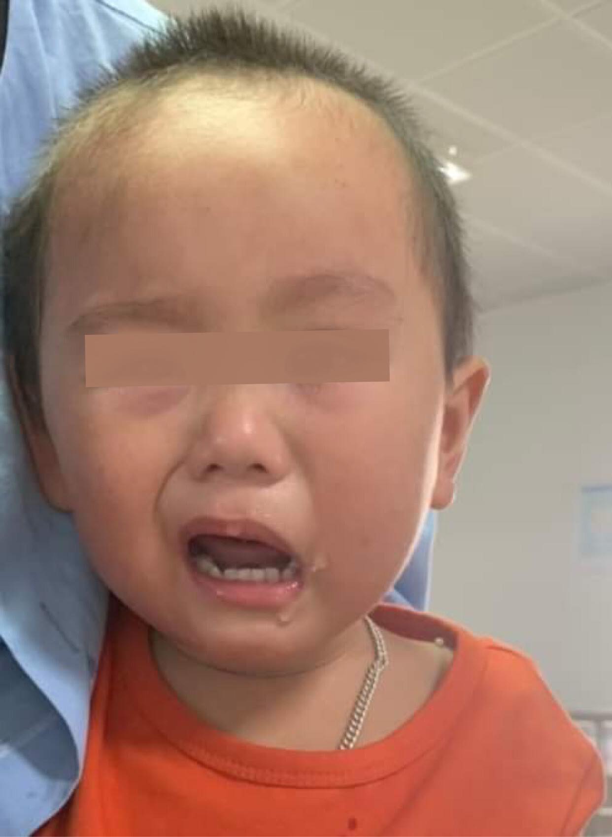 Trời rét đậm, rét hại, bé 2 tuổi nhập viện trong tình trạng méo miệng, liệt dây thần kinh số 7 - Ảnh 1