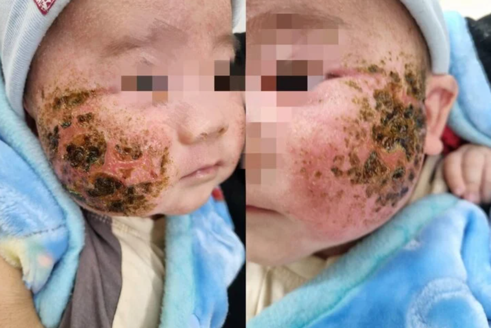 Tự đắp lá cây chữa viêm da, bé trai 4 tháng tuổi bị loét má nặng - Ảnh 1