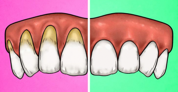 4 dấu hiệu chứng tỏ bạn đang đánh răng quá mạnh - Ảnh 1