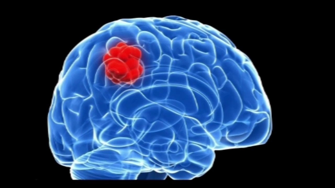 Ca sĩ Lương Bích Hữu phát hiện khối u trong não sau tai nạn: Tình hình sức khỏe mới nhất - Ảnh 1