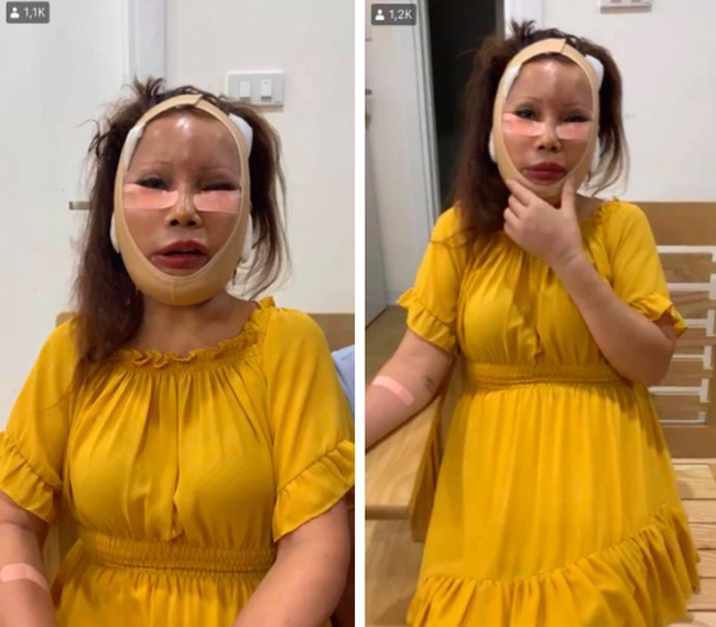 Cô dâu 63 tuổi ở Cao Bằng sau 2 tháng phẫu thuật căng da mặt, diện mạo khiến ai cũng “đồng ý là dao kéo hỏng” - Ảnh 1
