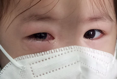 Trẻ mầm non đi học giữa mùa dịch đau mắt đỏ: Bác sĩ khuyên những việc cần làm để phòng bệnh - Ảnh 2