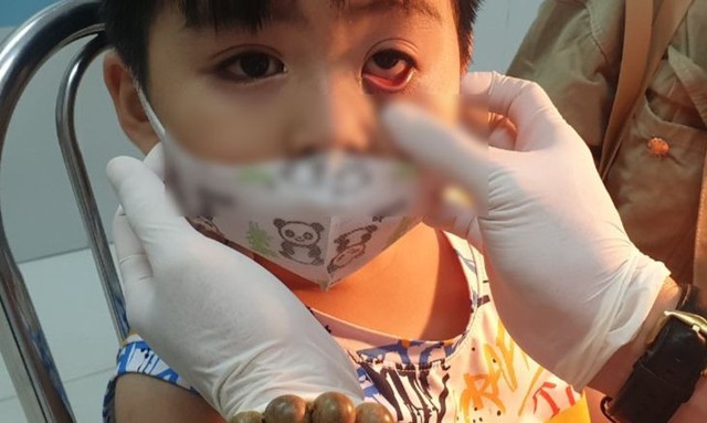 Trẻ mầm non đi học giữa mùa dịch đau mắt đỏ: Bác sĩ khuyên những việc cần làm để phòng bệnh - Ảnh 1