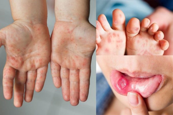 Cảnh báo nguy cơ lây lan bệnh tay chân miệng ở trẻ tăng cao trong bối cảnh bắt đầu năm học mới - Ảnh 1